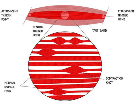 Spinal Decompression | Elevate Wellness Chiropractic