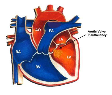 Valve Regurgitation Of Heart at Carolyn Pless blog