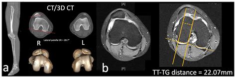 Reconstruction of High-Grade Trochlea Dysplasia in a Young Female with Recurrent Patella ...