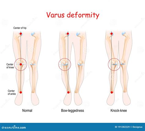 Valgus Vs Varus Of Ankle
