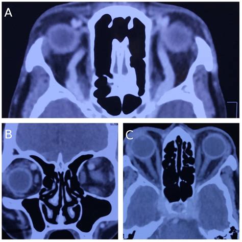 A rare case of Bilateral ocular paralysis