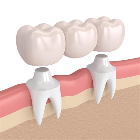 Dental Bridge | Tooth Crowns & Bridges Auckland | CM Dental