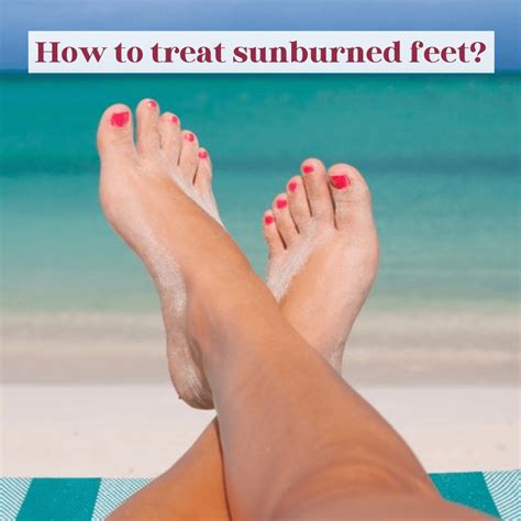 Feet Swelling From Sunburn at Bernard Baril blog