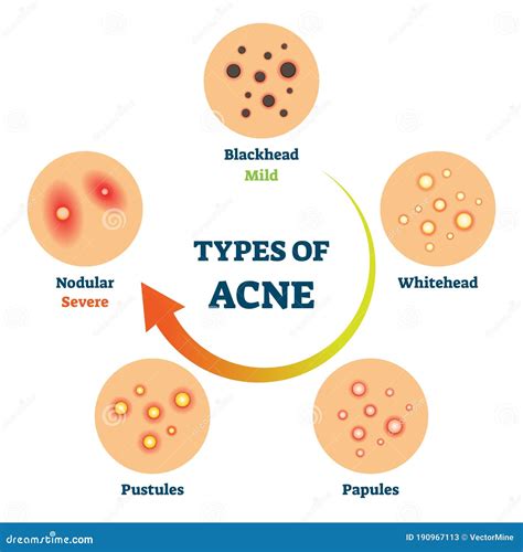 Types of Acne As Medical Skin Disease Comparison Scheme Vector Illustration Stock Vector ...