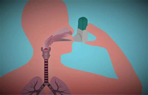 Easy Breathing improves effectiveness of dry powder inhalers, says study