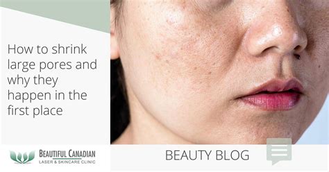 What Causes Face Pores at Molly Dorian blog