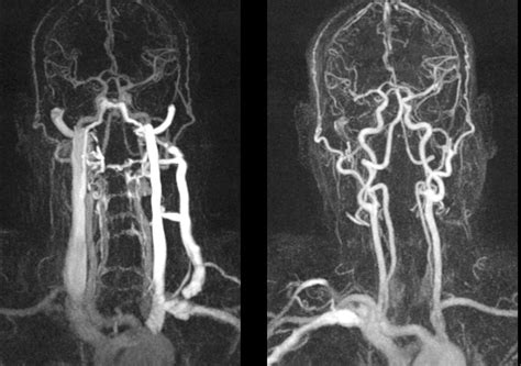 Ct Angiogram And Angiography