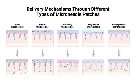 Delivery Mechanisms Through Different Types of Microneedle Patches | BioRender Science Templates