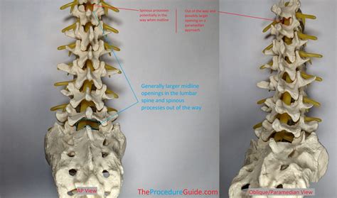 Lumbar/Thoracic Epidural Catheter Insertion – Technique and Overview ...