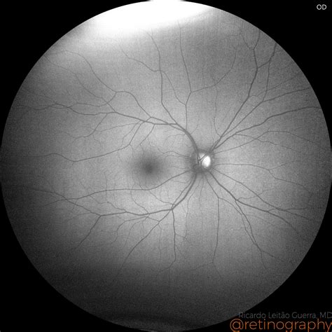 Optic disc drusen – Retinography