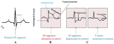Q Waves On Ekg