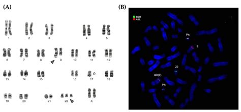 Chronic Myelogenous Leukemia with Double Philadelphia Chromosome and ...