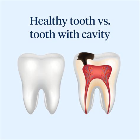 What Do Cavities Look Like Before The Treatment