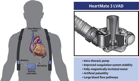 Trends and Outcomes of Left Ventricular Assist Device Therapy: JACC ...