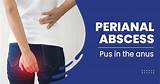 Perianal Abscess Surgery - Perianal Abscess Causes, Symptoms & Prevention