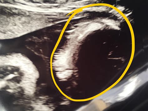 30 Weeks Ultrasound