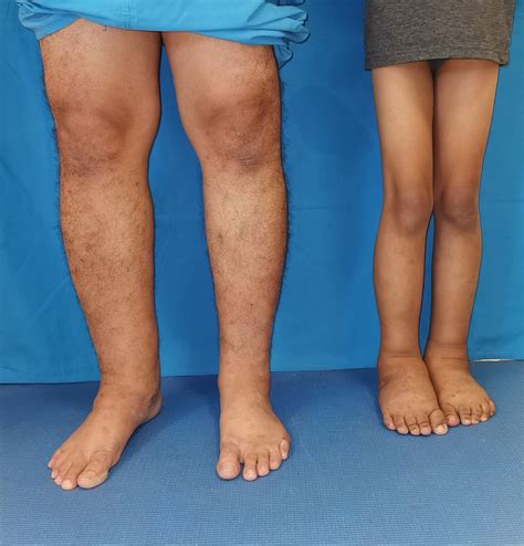 Primary Lymphedema in a Pediatric Patient | Consultant360