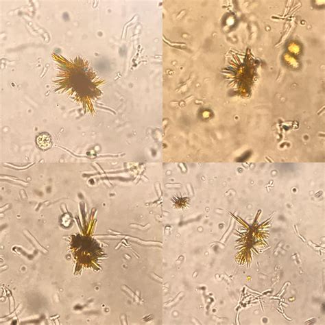 Bilirubin Crystals In Urine