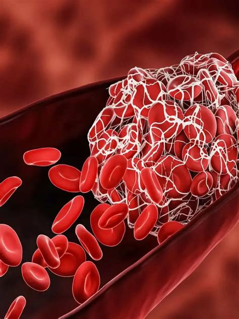 Amyloidosis क्या है? | Navbharat Times