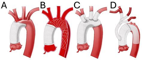 The Management of the Aortic Arch in Type A Aortic Dissection: Replace ...