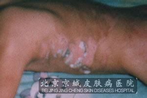 疤痕疙瘩恢复情况怎么样_瘢痕疙瘩_北京京城皮肤病医院(北京医保定点机构)