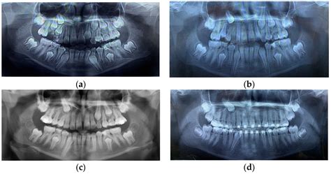 Dilaceration Teeth
