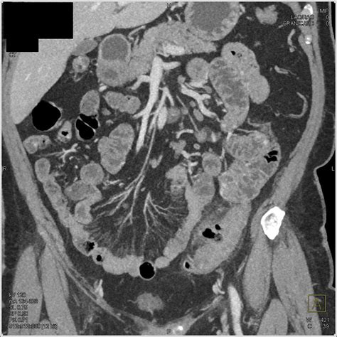 Diverticulitis Sigmoid Colon - Colon Radiology Case Studies - CTisus CT ...