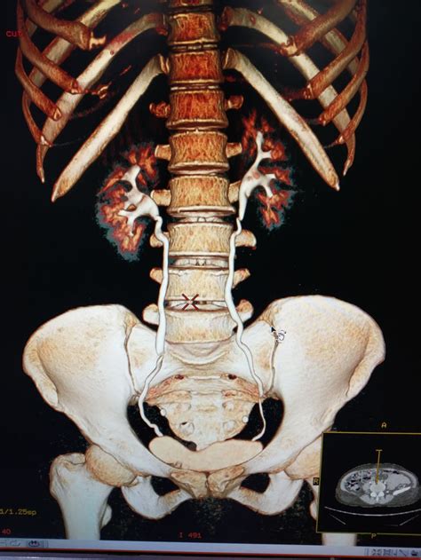 Image result for What Is a CD Urogram Scan Procedure