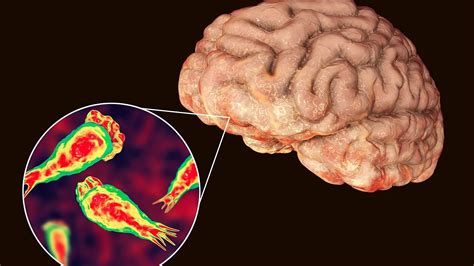 Mumbai Monsoon: Brain-Infecting Tapeworm On The Rise; Know Symptoms ...