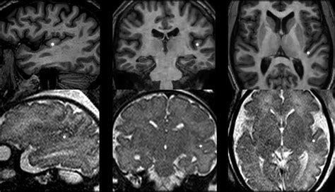 Fetal MR Imaging Anatomy of the Transverse Temporal Gyrus (Heschl Gyrus ...