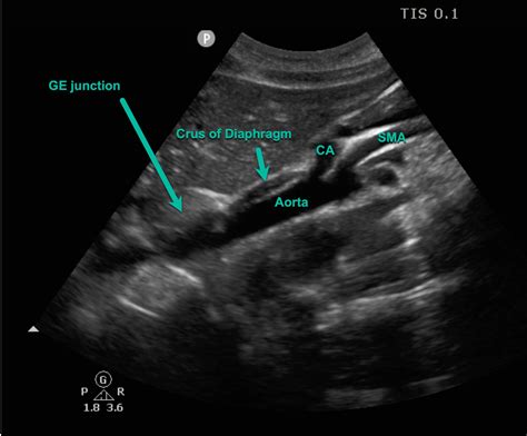Gastroesophageal Junction Ultrasound