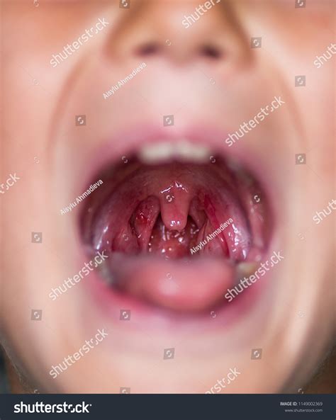 Ulcer On Tonsil Canker Sore Hi Res Stock Photography And Images