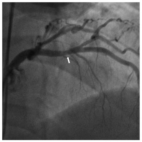 Near-Infrared Spectroscopy Intravascular-Ultrasound-Guided Intervention ...