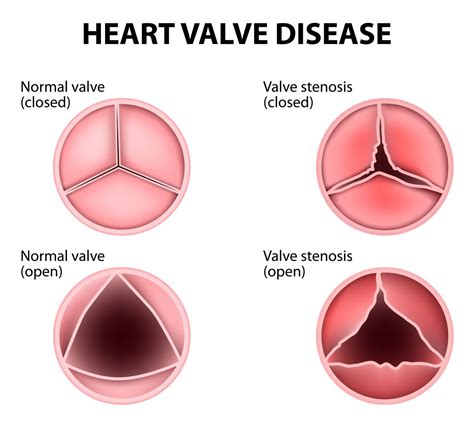 Leaky Valve In Heart