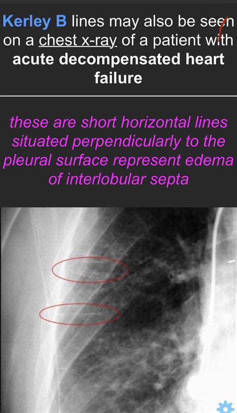 Why are kerley b lines also seen in decompensated heart failure? : r/step1