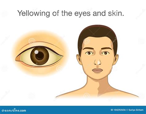 Yellowing of the Eyes and Skin. Stock Vector - Illustration of gallbladder, cirrhosis: 104292656