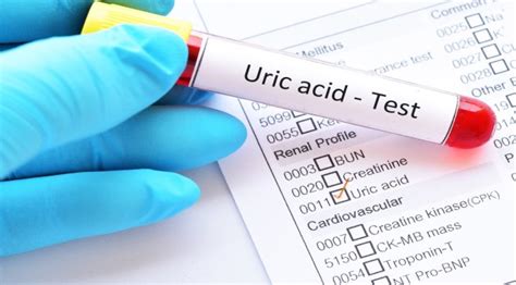 Mastering Uric Acid: Symptoms, Causes, and Lifestyle Strategies for ...