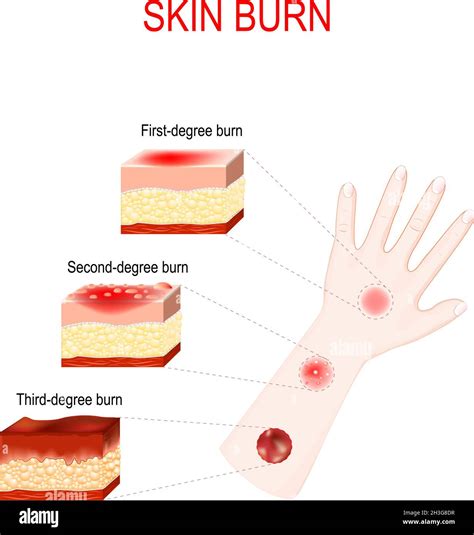 What Do 1st 2nd And 3rd Degree Burns Look Like A Visual First Aid For