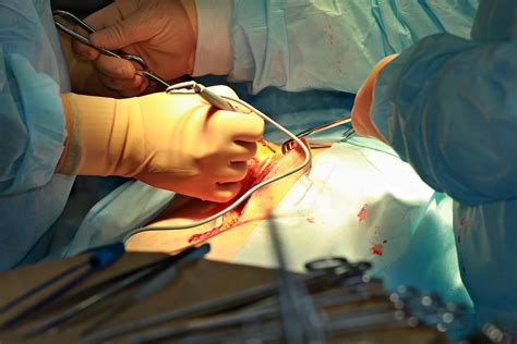 Gastrectomy : गैस्ट्रेक्टमी क्या है? जोखिम, प्रक्रिया, रिकवरी - हैलो ...