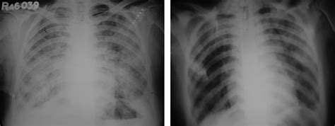 Anesthesia Airway Lavage 的图像结果