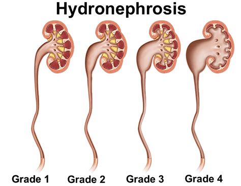 Hydronephrosis Grading Ultrasound