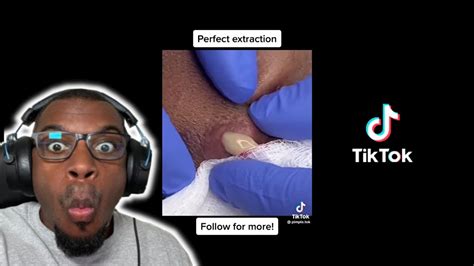 Image result for Worst Exploding Pimple