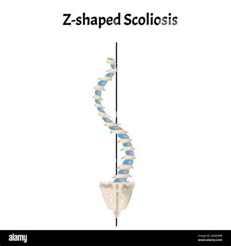 Lumbar Lordosis High Resolution Stock Photography and Images - Alamy