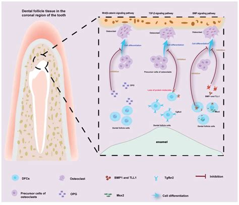 Abnormal dental follicle cells: A crucial determinant in tooth eruption disorders (Review)