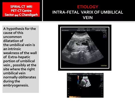 Dilated intra abdominal fetal umbilical vein | PPTX