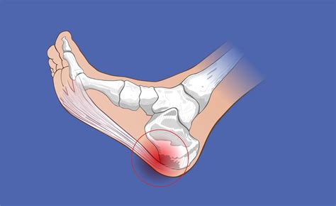 ¿Qué es la Fascitis Plantar? | Pisando Firme