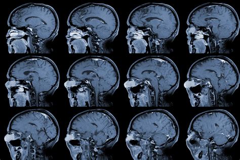 Aneurisma cerebral: principales riesgos y opciones de tratamiento ...