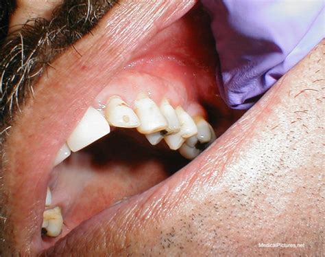 Bildergebnis für ruptured abscess in mouth