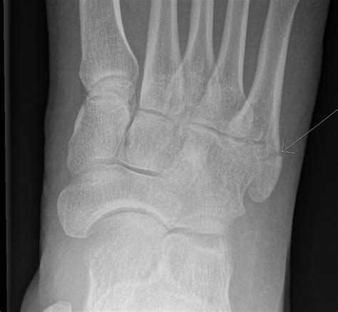 Intra-articular base of 5th metatarsal fractures (Zone 2) – Should we ...