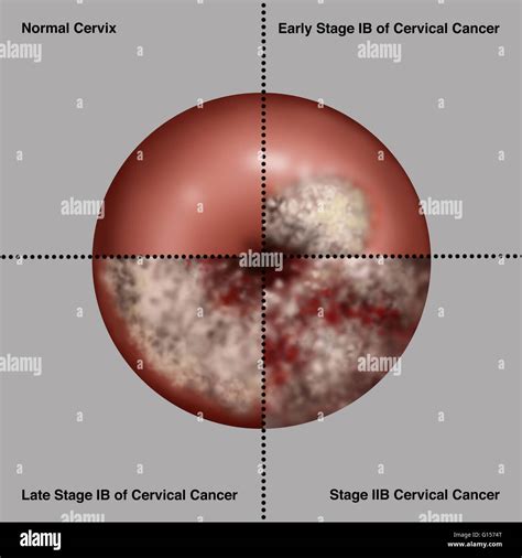 Illustration showing the progression of cervical cancer. Upper left ...